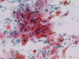 喀痰中に認められたがん細胞